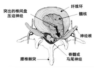 腰椎间盘突出你还在把缓解方式当做改善吗（图）_2