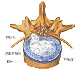 腰椎间盘突出你还在把缓解方式当做改善吗（图）_3