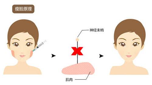 商丘華美整形可靠嗎？瘦臉針多少錢(qián)一次？（圖）_1