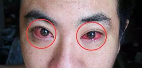 眼科专家：夏天红眼病高发期，我们应该如何预防（图）_1
