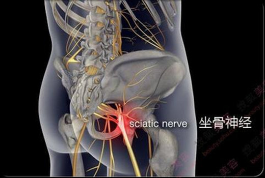 坐骨神經(jīng)痛試試這個(gè)方法避免吃藥打針（圖）_1