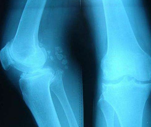 骨質(zhì)增生怎么治骨質(zhì)增生用王九正貼效果好嗎？_1