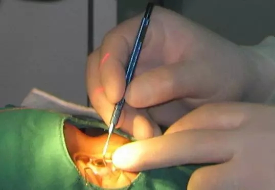 眼科專家：高考中考后，同學們需要激光手術(shù)如何選擇（圖）_1