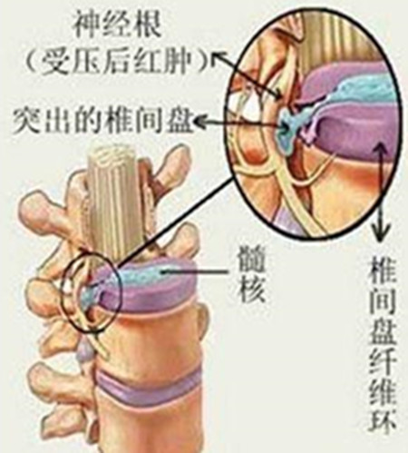 腰椎間盤突出保守治癒的好方法小編解密圖