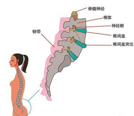 腰椎間盤突出保守治愈的好方法小編解密（圖）_2