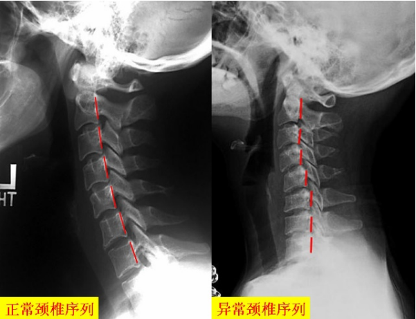 改善骨質(zhì)增生的根除方法誰(shuí)知道？_1