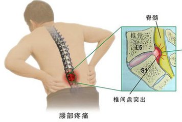 腰椎间盘突出难治中医膏药贴效果确切（图）_1