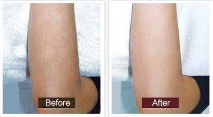 opt痛脫毛儀多少錢(qián)opt痛脫毛儀批發(fā)市場(chǎng)價(jià)格（圖）_2