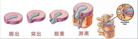 腰椎间盘突出治不好别担心，教您一招简单又省钱（图）_1