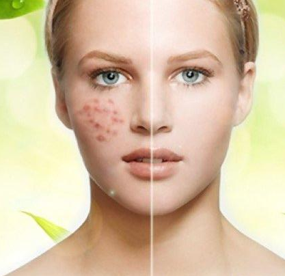 用對方法去除痘坑痘疤不再是夢?。▓D）_2