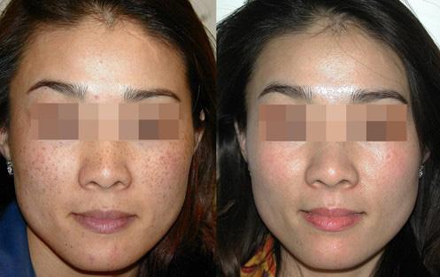 最先進(jìn)的祛斑儀器排行榜（圖）_1