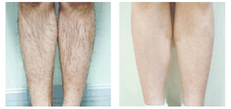 適合美容院用的脫毛儀是哪種？（圖）_1