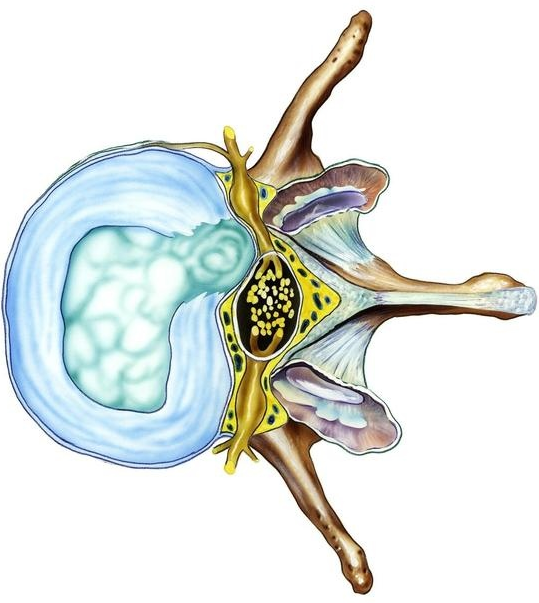 為什么說腰間盤突出不難治？你卻治不好原因是沒用對(duì)方法!（圖）_1