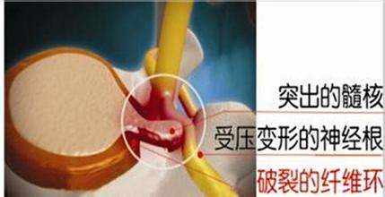 改善腰椎間盤突出，方法你選對了嗎？（圖）_1
