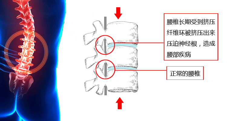 如何高效改善腰椎間盤突出才是上上策_(dá)1