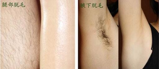 美容院都有哪些比較先進(jìn)的脫毛儀器？（圖）_1