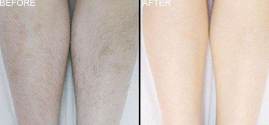 最新脫毛儀器設備多少錢（圖）_2