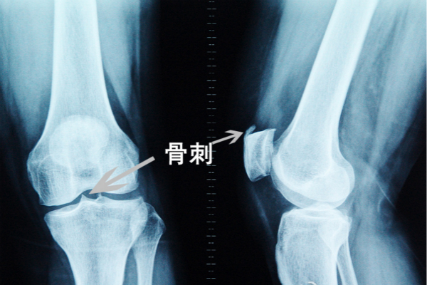 骨質(zhì)增生真的只是那么簡單嗎？找到這個方法輕松解決疼痛（圖）_1