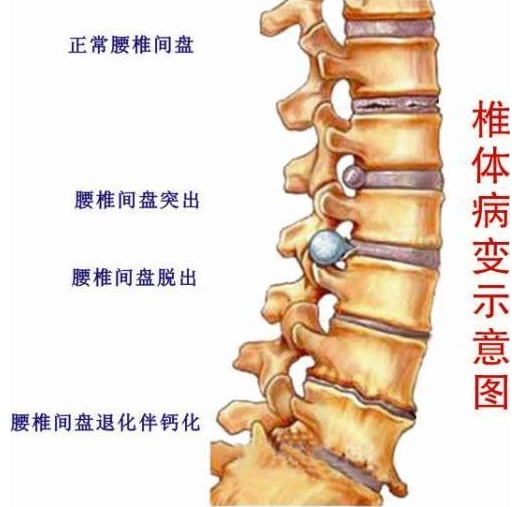 腰間盤突出有救了，真實(shí)有用的方法大全（圖）_2