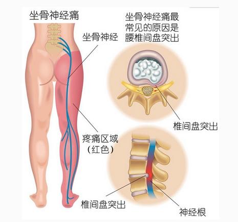 腰间盘突出不容小瞧,切记及时改善_3