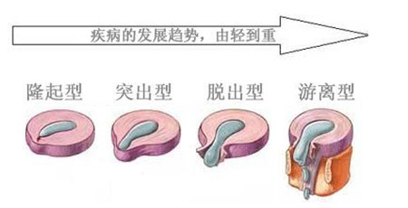 不要讓腰椎間盤突出愛“愛”上你，找準改善方法是關鍵（圖）_2