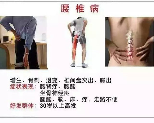 腰椎間盤突出壓迫神經(jīng)腿疼怎么治效果好_2