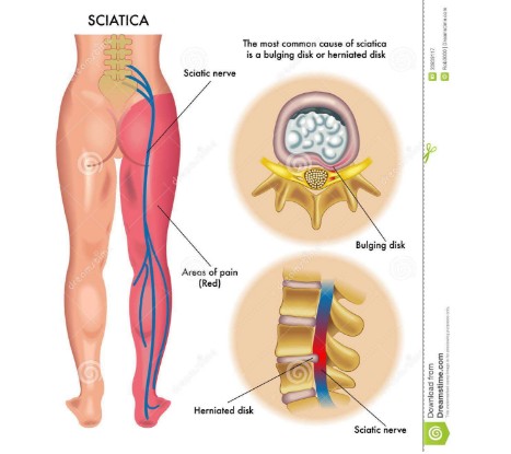 腰椎間盤突出原因、癥狀，能根治嗎？（圖）_1