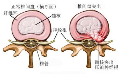 腰椎間盤突出原因、癥狀，能根治嗎？（圖）_3