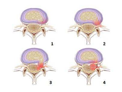 腰椎間盤突出原因、癥狀，能根治嗎？（圖）_2