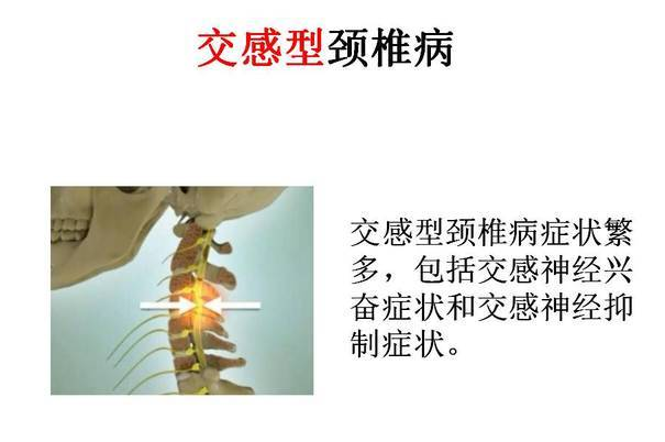 交感型頸椎病保守改善可行嗎？采取啥保守改善（圖）_1