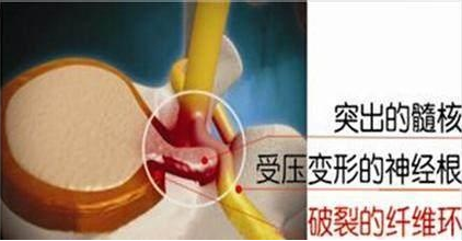 還在發(fā)愁腰間盤突出？看一下奶奶給我打聽(tīng)的治腰好法子（圖）_1