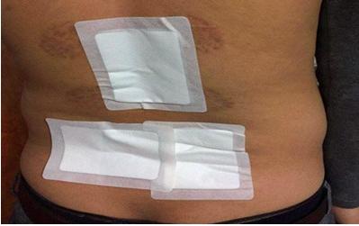 腰肌勞損常見的治愈方法這里都全了_5