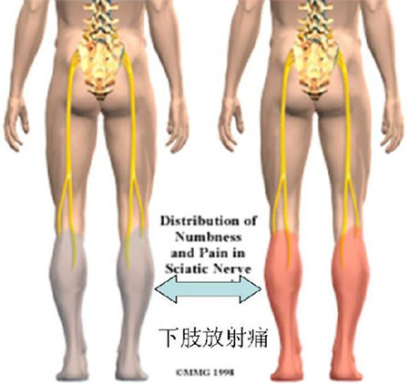 2017改善腰椎間盤突出這個(gè)方法簡(jiǎn)單花錢少_2