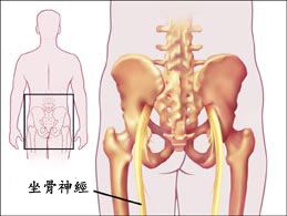 坐骨神经疼痛难忍，乔氏黑玉膏帮您轻松解决（图）_1