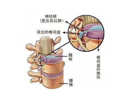 口碑相傳，改善腰椎疾病就選喬氏黑玉膏帖（圖）_1