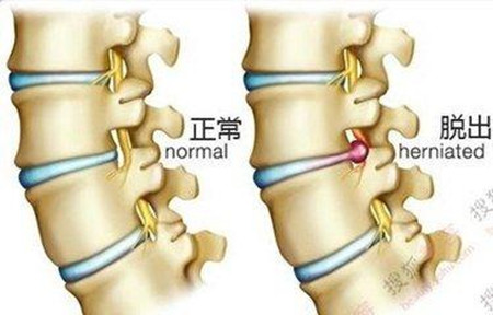 腰椎间盘突出怎么治才好，教您民间一招快速治愈（图）_3