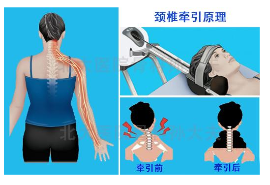 頸椎病改善有竅門，趕緊學(xué)起來(lái)一起做！（圖）_4