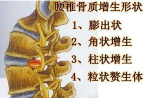 腰间盘突出特效方你听说过吗？方便还管用！（图）_1