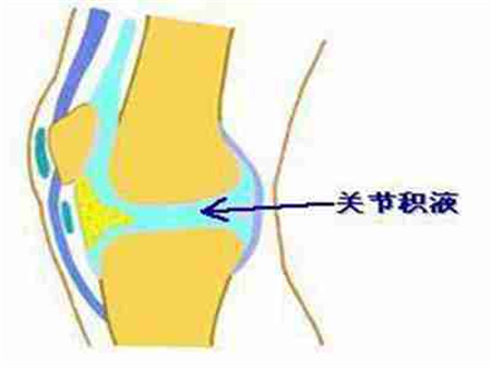 醫(yī)學(xué)界告訴大家這樣改善滑膜炎，要堅(jiān)持改善_2