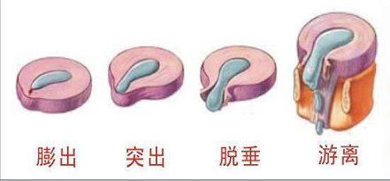 腰椎間盤突怎么改善才好，用喬氏黑玉膏就夠了_1