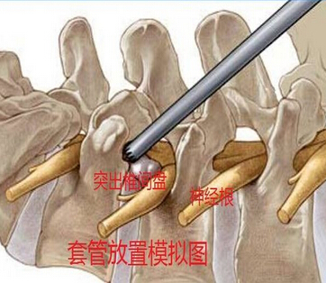 簡單說說腰椎間盤突出手術(shù)和非手術(shù)的關(guān)鍵點_1