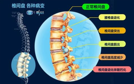 得了腰椎間盤突出怎么辦？膏藥一貼，好的快！（圖）_1
