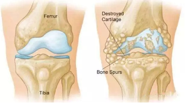 一招解決膝關(guān)節(jié)疼痛，管用?。▓D）_3