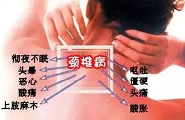 使用了王九正遠紅外理療貼，頸椎病不再讓我煩惱（圖）_2