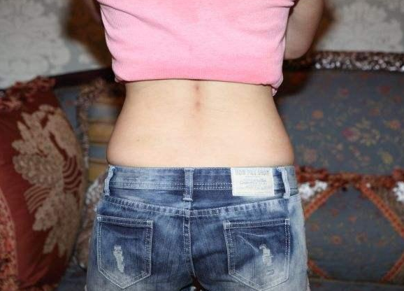 外用王九正貼可以治腰間盤突出嗎該怎么治才好？（圖）_1