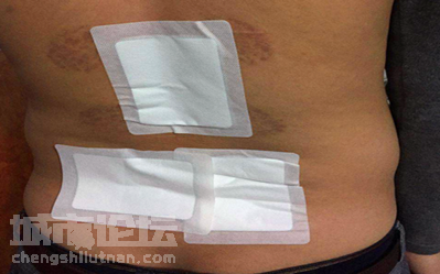 腰椎間盤突出怎么辦？原來改善這么簡單_3