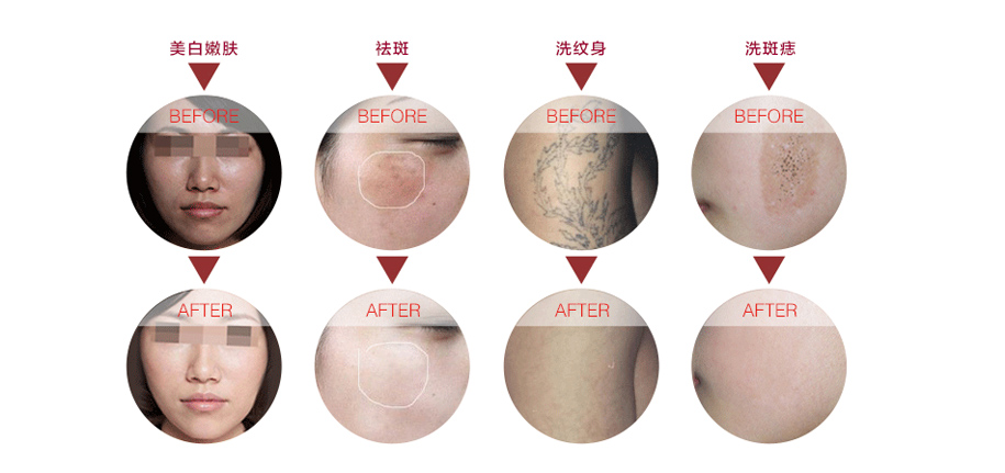 祛斑去紅血絲的美容儀器價(jià)格（圖）_1