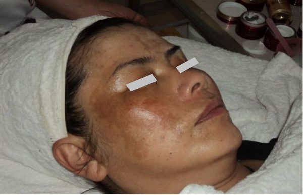 激光美容機(jī)器價(jià)格（圖）_1