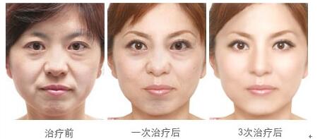 一臺ulthera機(jī)器多少錢（圖）_1