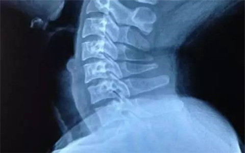 頸椎病是什么狀態(tài)，怎么改善？（圖）_2